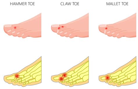 Hammer Toe Treatment & Exercises – Tom Biernacki