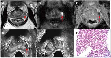 Biomedicines Free Full Text Comparison Of Targeted Biopsy And