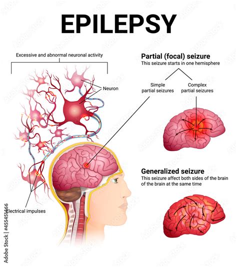 Types Of Epileptic Seizures Brain And Neurons Vector De Stock Adobe