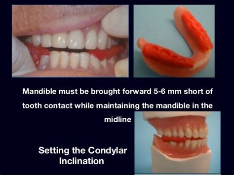 7 Try In Of The Wax Trial Complete Denture