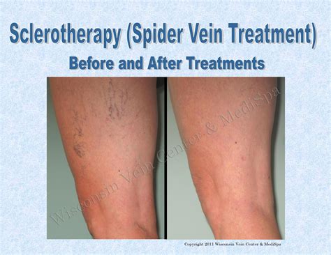 Sclerotherapy Is A Technique Which Involves The Use Of A Very Fine Needle To Inject A Solution