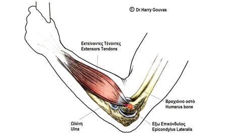 Placement of tennis elbow brace | General center | SteadyHealth.com