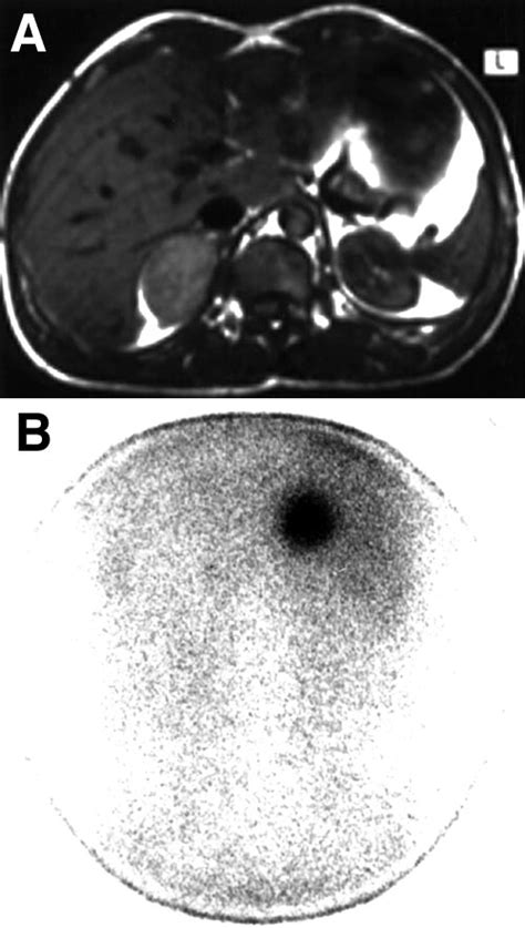 Patient With Nonhypersecreting Right Adrenal Pheochromocytoma A Download Scientific Diagram