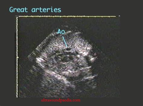 Double Inlet Ventricle Ultrasoundpaedia