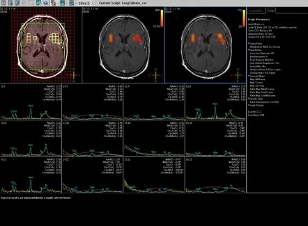 Subacute Cerebral Infarction With Mr Spectroscopy Image