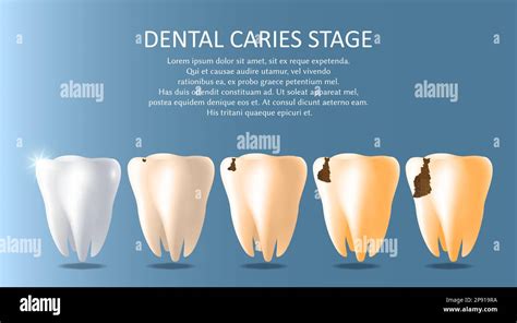 Dental Caries Stages Vector Medical Poster Banner Template Stock Vector