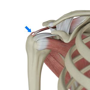 Rotator Cuff Calcification Columbia Arthroscopic Surgery Columbia