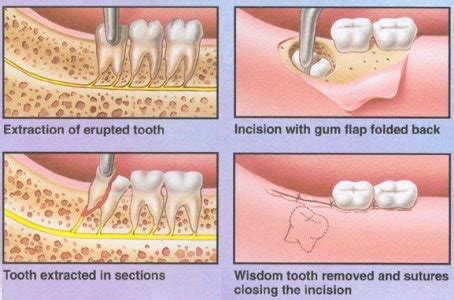 Wisdom Teeth Removal Stitches