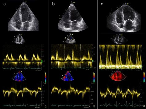 Echocardiographic Assessment Of Cardiac Remodelling And Diastolic Download Scientific Diagram