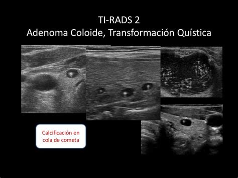 Nódulo Tiroideo Ti Rads Eco Baaf