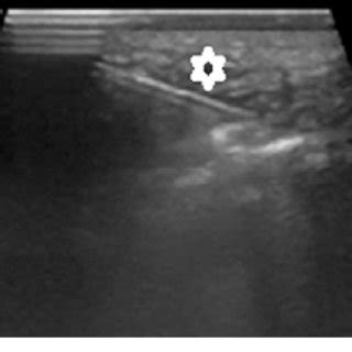 ultrasound image after injecting the PRP showing peppering technique;... | Download Scientific ...