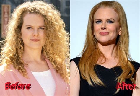 Nicole Kidman Before and After Cosmetic Surgery - Plastic Surgery Mistakes