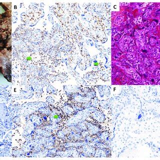 Macroscopic Histological And Immunohistochemical Findings Of The