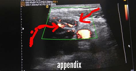 Ultrasound Imaging Acute Appendicitis Sonography