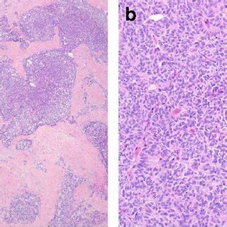 Mesenchymal Neoplasm With Actb Gli Fusion Showing A Nested