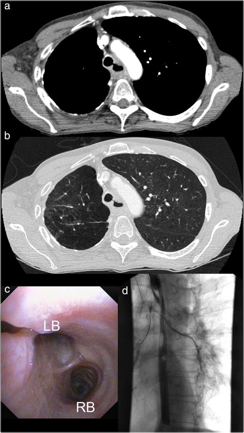Case 3 A Contrast Enhanced Cat‐scan In Bone Window Setting