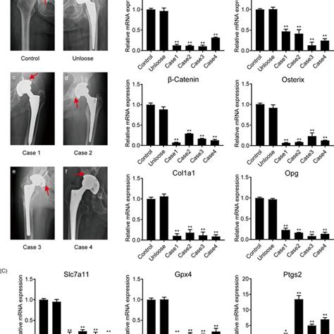 Preoperative Examination Of X‐rays From Patients With Aseptic Loosening Download Scientific