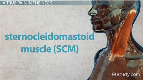 Sternocleidomastoid Syndrome | Cause, Symptoms & Treatment - Lesson ...