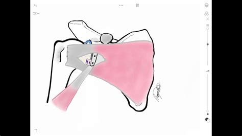 Cirurgia De Latarjet Para Tratamento Da Luxação Recidivante De Ombro