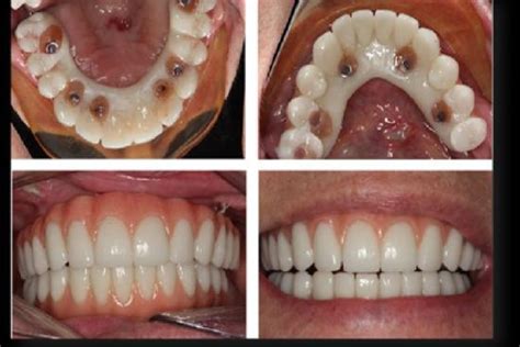 Implantes dentales All on 6 en Turquía Resultados y precio