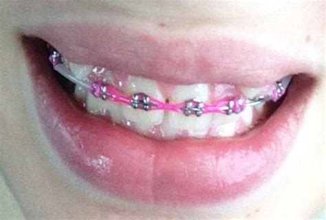 Pink Braces Pink Braces Braces Colors Cute Braces