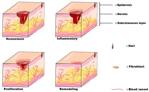 Recent Progress Of Electrospun Nanofiber Dressing In The Promotion Of Wound Healing