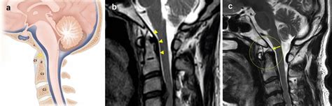 Sagittal View Of The Craniovertebral Junction A The Cruciate Download Scientific Diagram