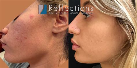 Acne Scars Before And After Chemical Peel