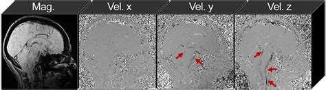 Fourdimensional Flow MRI For Quantitative Assessment Of Cerebrospinal