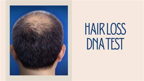 Male Pattern Baldness Causes And Treatment Options Hados Design