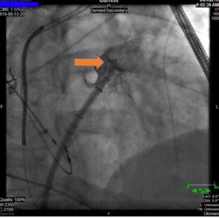 Fluoroscopic Image While Deploying The Left Atrial Occlusion Device