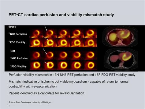 Ppt Pet•ct Cardiac Perfusion And Viability Mismatch Study Powerpoint