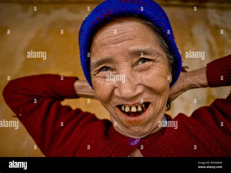 Stained Teeth Hi Res Stock Photography And Images Alamy