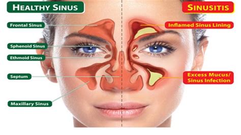 Apa Itu Sinusitis Inilah 6 Gejala Penyakit Sinus Yang Perlu Diwaspadai