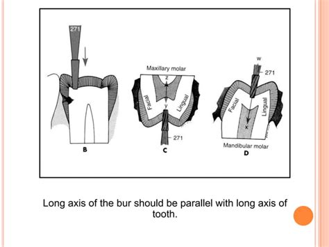 Cast Gold Inlay Restorations Ppt