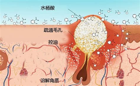 【水杨酸产品】怎么选？专业配方师带你研究【水杨酸】这把双刃剑，新手学生党再也不用怕烂脸爆痘了！黑头、粉刺、痘痘全都击破！ 知乎