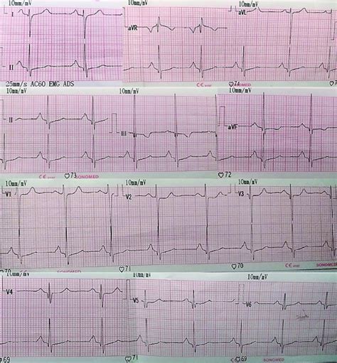 Sintomas De Hipertrofia Biatrial Retoedu