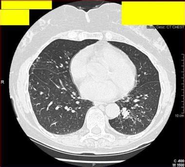 Mycobacterium avium-intracellulare infection; Mycobacterium intracellulare Infection