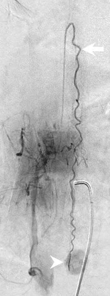 Spinal Catheter Angiography Injected Through The Right Lumbar Artery At