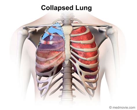 Collapsed Lung