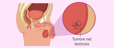 Cancro Ai Testicoli