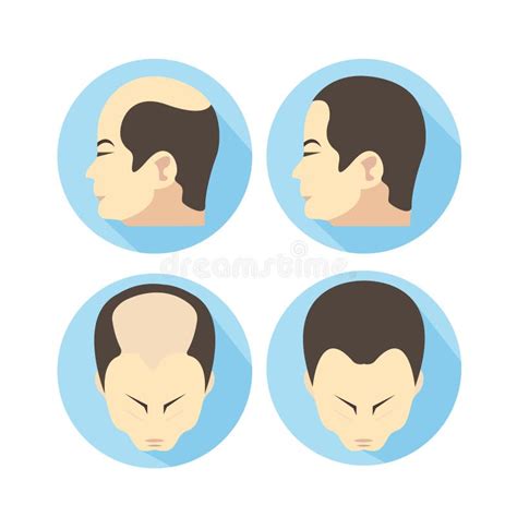 Hair Loss Man Stages Stock Illustrations 191 Hair Loss Man Stages