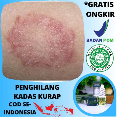 Salep Menyembuhkan Kadas Kurap Jamur Kulit Eksim Kudis Scabies