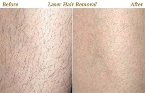 Laser Hair Removal Legs Cost Change Comin