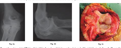 Figure 2 From Long‐term Results Of The Lateral Resurfacing Elbow