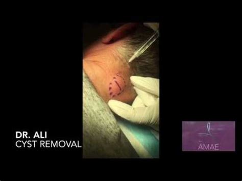 Must See Cyst Removal Part I Youtube