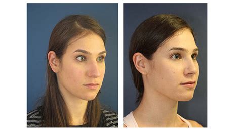 Rhinoplasty Before And After Gallery Mount Sinai New York