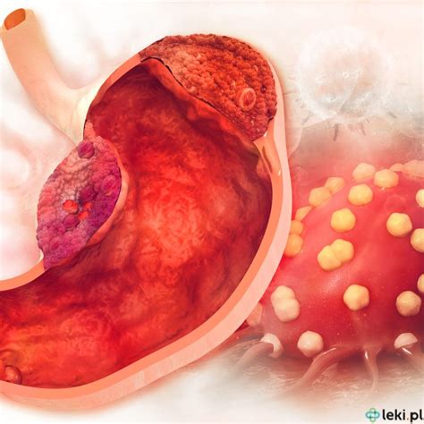Jakie są nowoczesne leki na raka żołądka leki pl