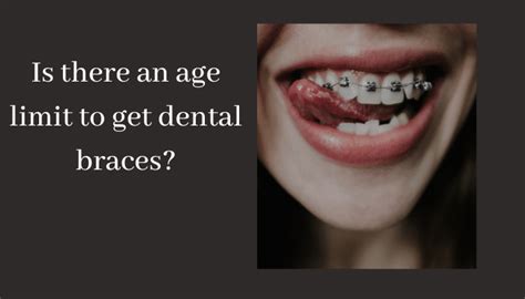 Is There An Age Limit To Get Dental Braces Vistadent