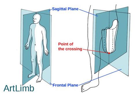 Prosthetic Alignment Part2 The Socket Artlimb Lower Limb Sagittal Plane Alignment